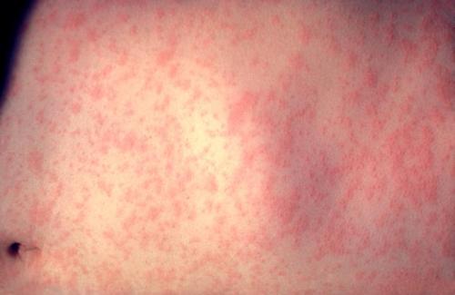 Skin with measles