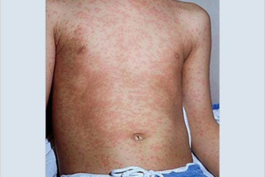 Measles Rash on child's chest